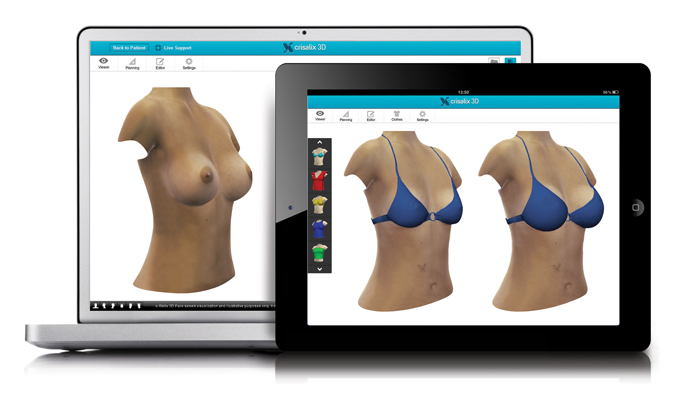 3D Simulation vor der Brustvergrößerung