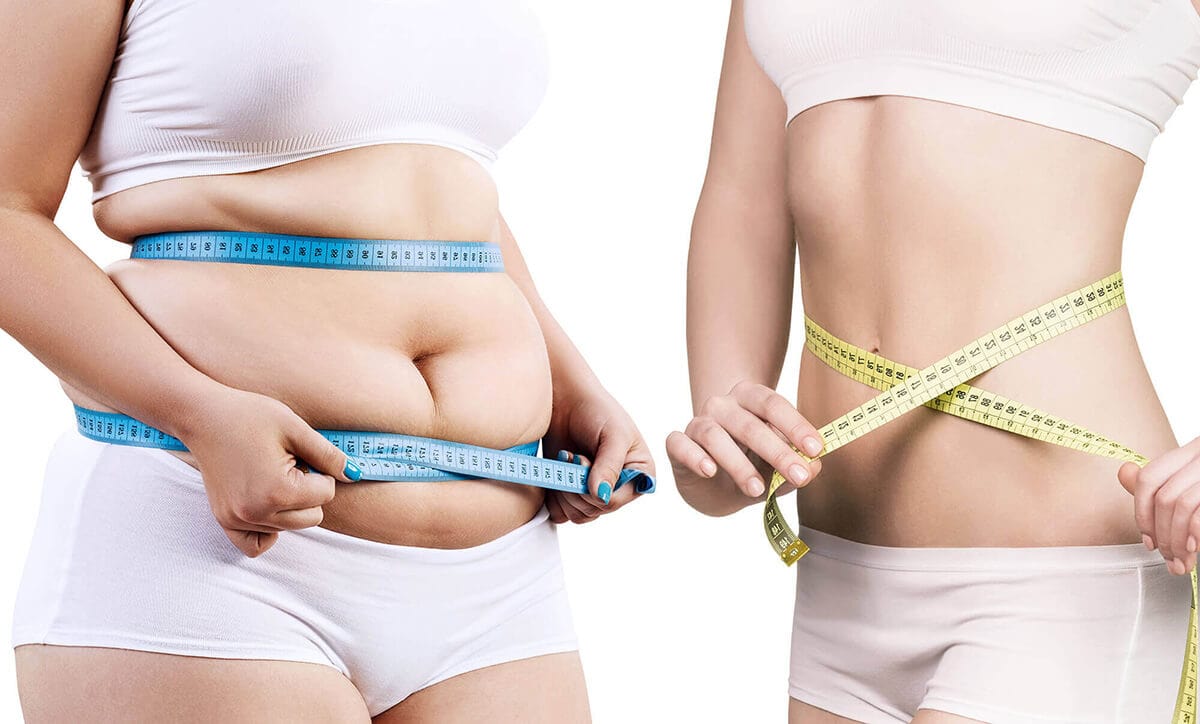 Fett reduzieren durch Fett-Weg-Spritze, Liposuktion und Hautstraffung
